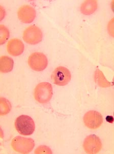 Babesia-infected cells: Courtesy CDC/Dr. George Healy
