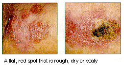 [Two pictures of skin cancer: a flat, red spot that is rough, dry or scaley]