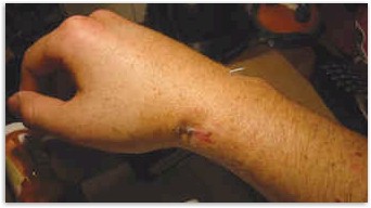 Picture of the injured wrist.
