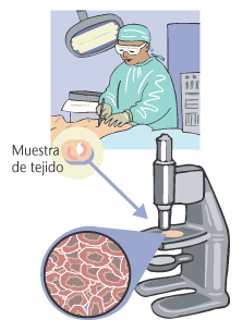 Ilustracin de un mdico utilizando un bistur para remover una muestra de tejido de un paciente.