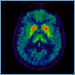 Brain with PARK8-linked parkinsonism
