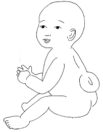Representation of baby with spina bifida