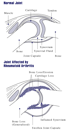 Normal Joint and Joint affected by Rheumatoid Arthritis