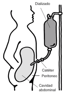 La ilustracin de una persona para se tratar con el dilisis de peritoneal.