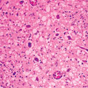 This slide shows tissue from a brain of a mule deer infected with chronic wasting disease. Abnormal prion proteins accumulate in the brain and destroy nerve cells. The destruction of nerve cells creates lesions, which give the tissue the spongy appearance shown here. This image was taken as part of a research project on 