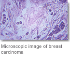 Microscopic image of breast carcinoma