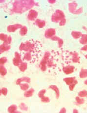 Gonorrhea - gram stain
