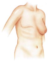 post mastectomy