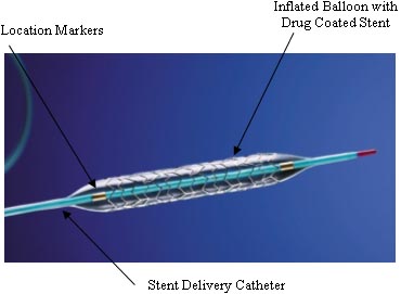 (Illustration of the device, indicating the location markers, inflated balloon with drug coated stent, and stent delivery catheter.)