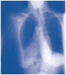 Anlisis de laboratorio de fluidos o tejido de los pulmones.