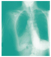 La TB afecta slo los pulmones?