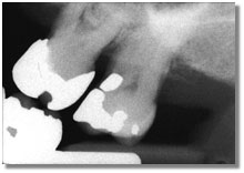 ADIS match x-rays of the same teeth at a different angle