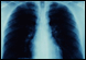 Don't Smoke! Lung x-ray from a former smoker