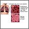 COPD (Chronic Obstructive Pulmonary Disorder)