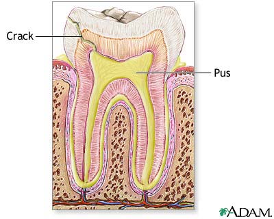 Tooth abscess