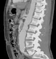 A reformatted image of the lumbar spine and abdominal aorta looking from the side. The front of the abdomen is to the left and the patient's back is to the right of the image.