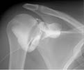 Iodine contrast material has been injected into the shoulder joint - this is a shoulder arthrogram.
