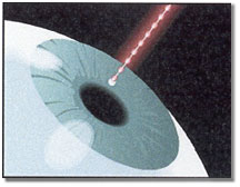 Close-up illustration of eye and pulsion laser beam