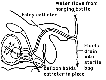 Side view diagram of male urinary tract with Foley catheter in place to drain urine. A balloon near the tip holds the catheter in place.