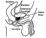 Side view diagram of male urinary tract showing how an enlarged prostate can squeeze the urethra and block urine flow.